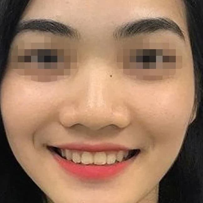 An Nhien Dental patient after orthodontic treatment