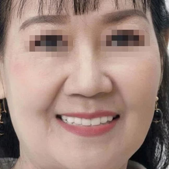 An Nhien Dental patient after aesthetic ceramic restoration