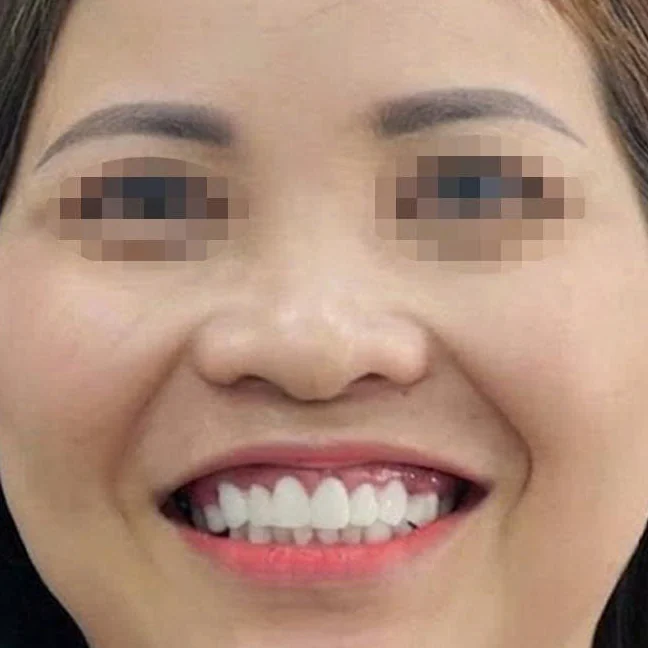 An Nhien Dental patient after implant restoration
